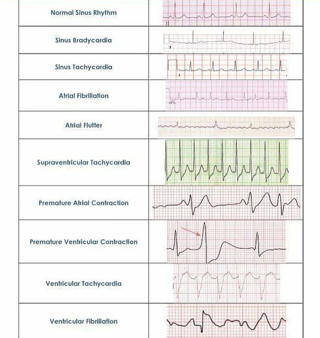 Medical Doctors on Instagram: âNormal sinus rhythm vs. abnormal rhythm ...