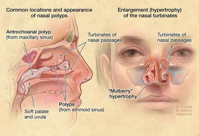 MEDICAL SCHOOL: nasal polyps,what to know? in 2020 ...