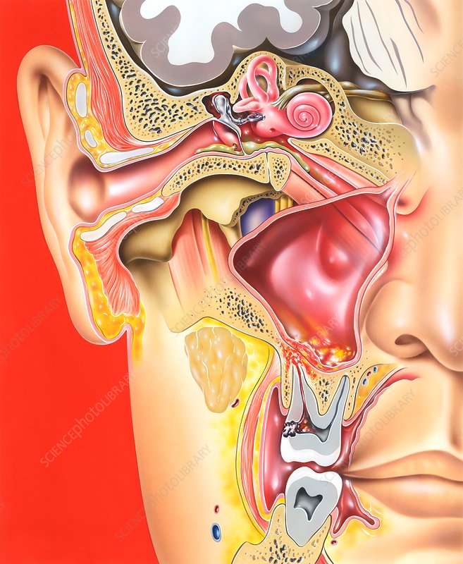 Middle ear, tooth and sinus infections, illustration ...