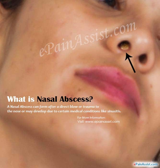 Nasal Abscess Gallery