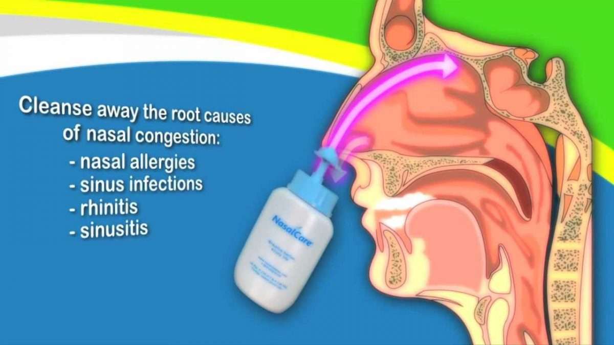 Nasal Irrigation to Treat Sinusitis Common Cold Allergy
