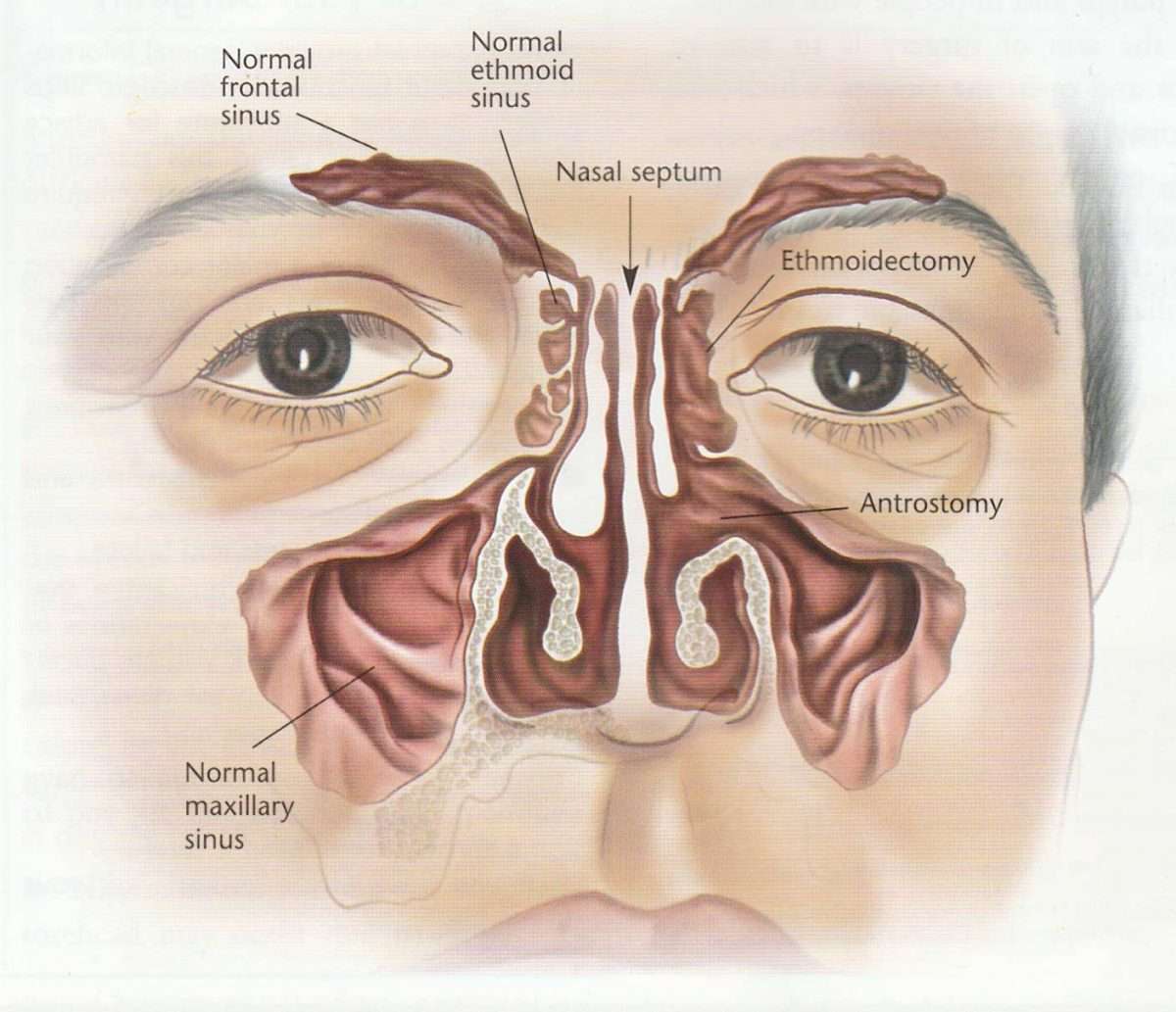 Nasal Polyps And Sinus Infection
