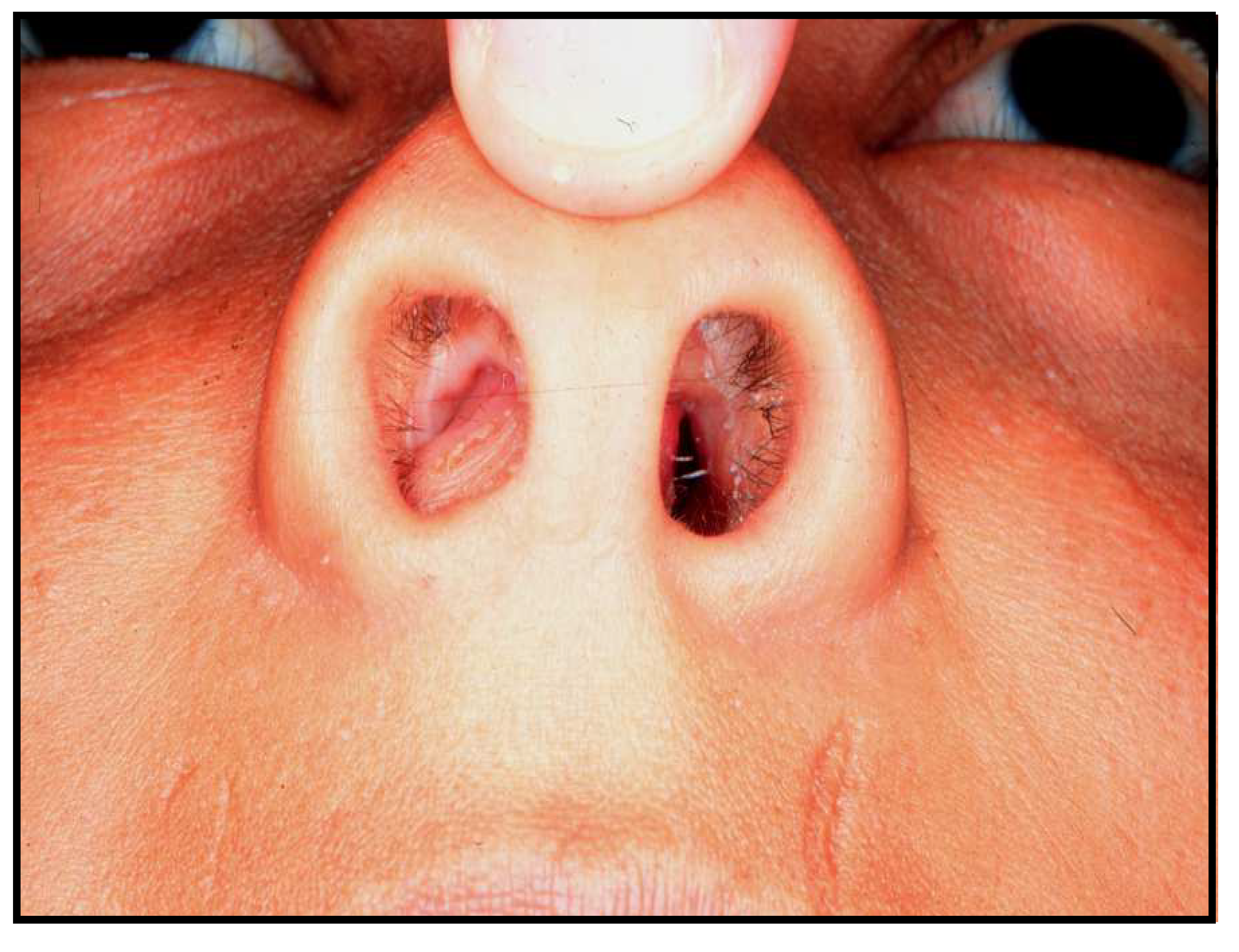 Nasal Polyps Vs Normal : Nasal papilloma vs polyp