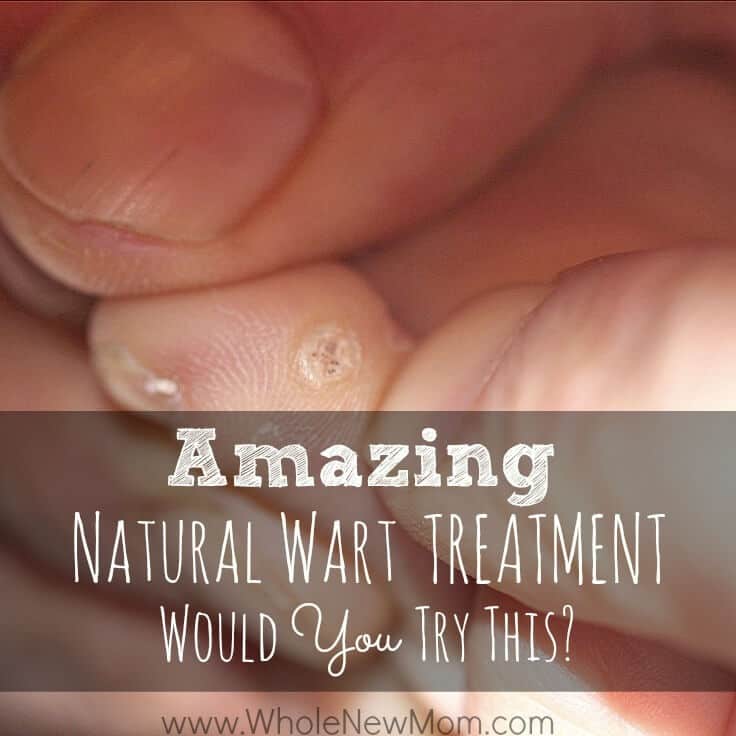 Natural Remedies for Warts {&  an Unbelievable One!}