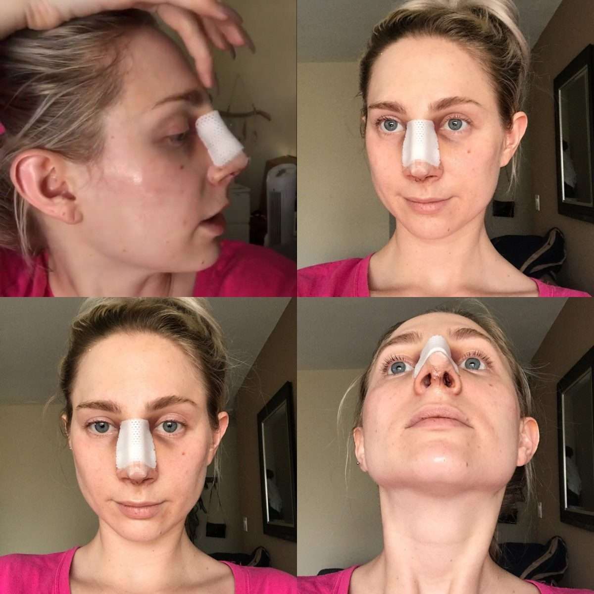 Nose Job: Surgery, Recovery, Cast Removal &  Two Week Post