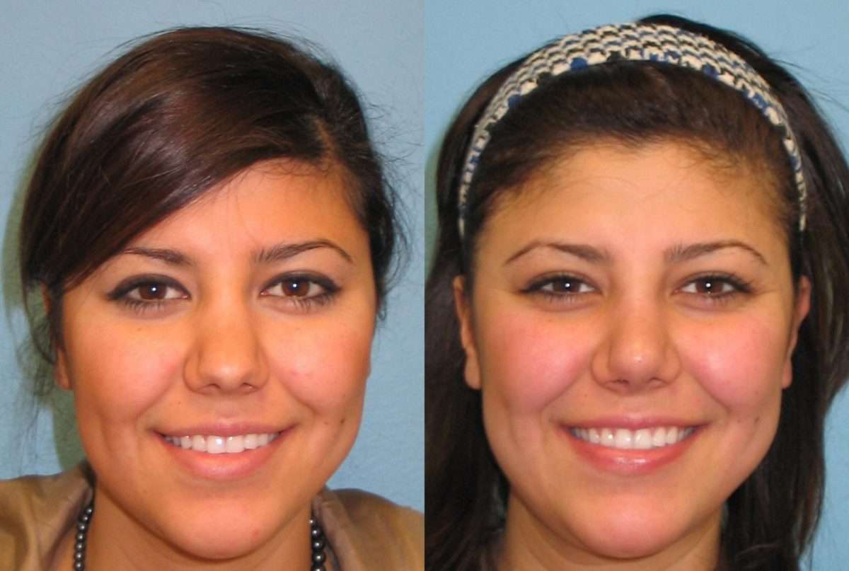 Nose Surgery Before &  After Photos Patient 39
