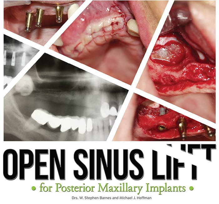Open Sinus Lift by Drs. W. Stephen Barnes and Michael J. Hoffman ...