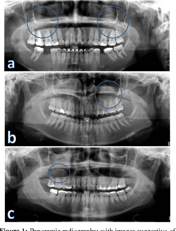 [PDF] Frequency of Maxillary Sinus Mucous Retention Cysts in a Central ...