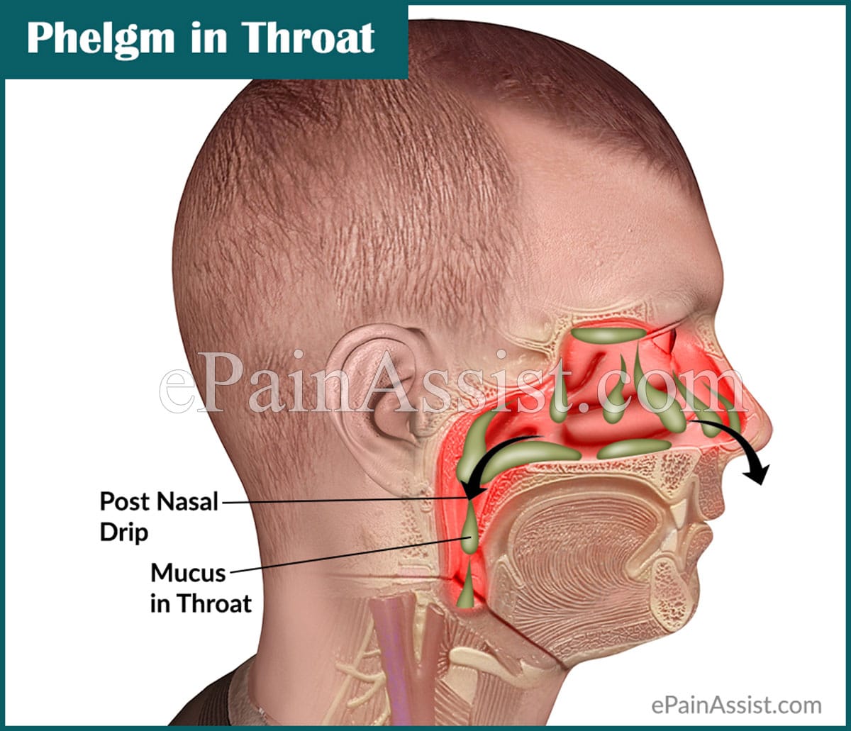 Phlegm in Throat or Mucus in Throat: Causes &  Ways to Get Rid of it!