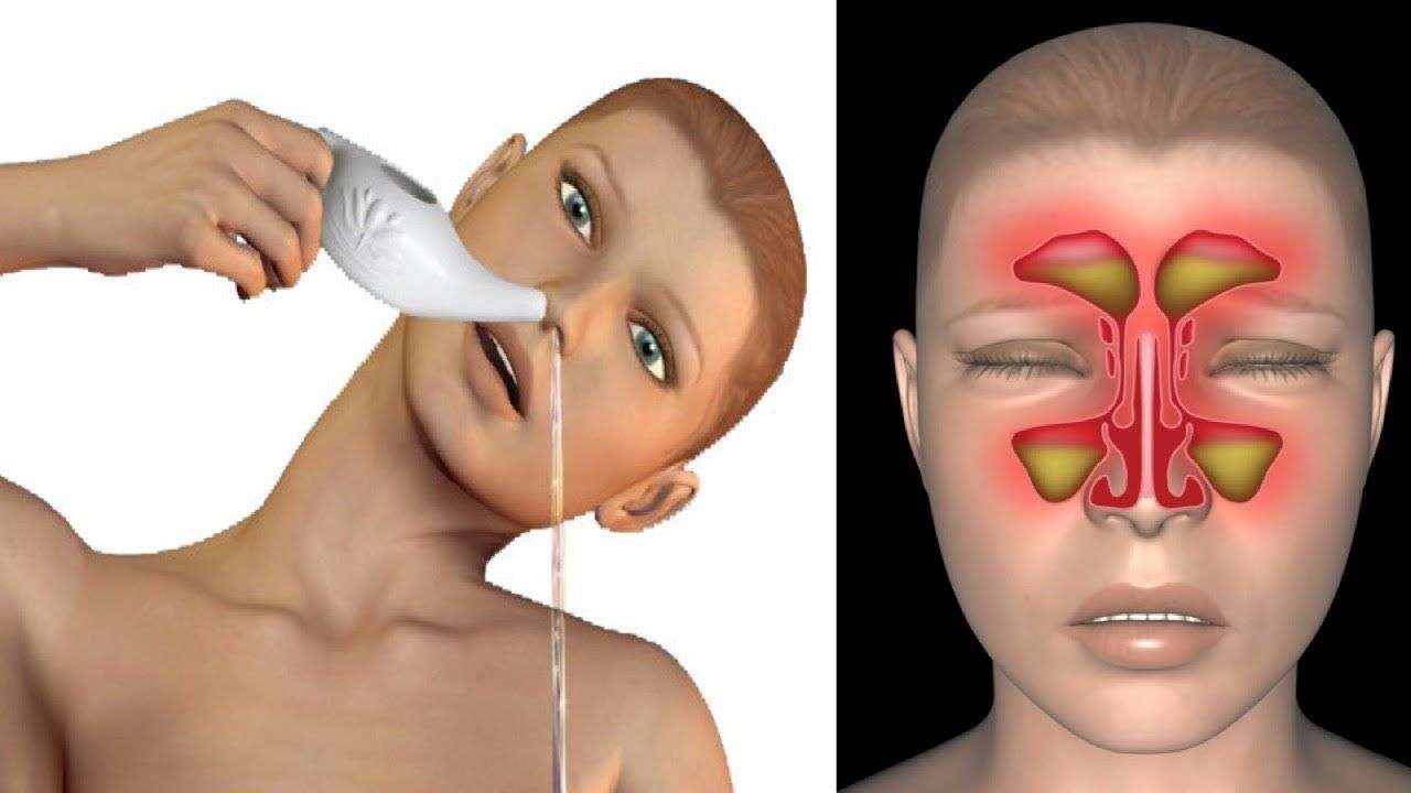 Powerful Natural Remedies To Relieve Sinus Pressure And Congestion In ...