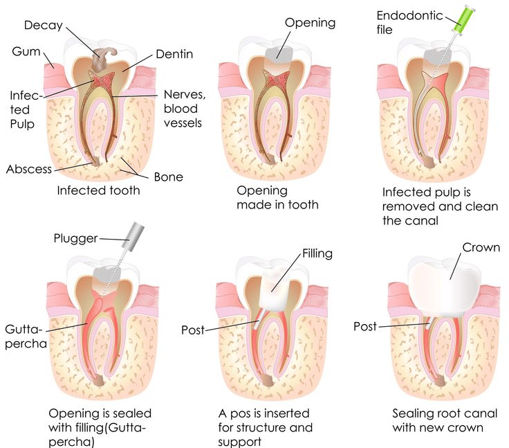 Root canal treatment (endodontic treatment) explained