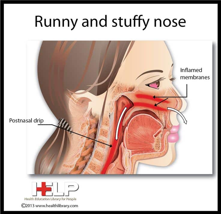 Runny and Stuffy Nose