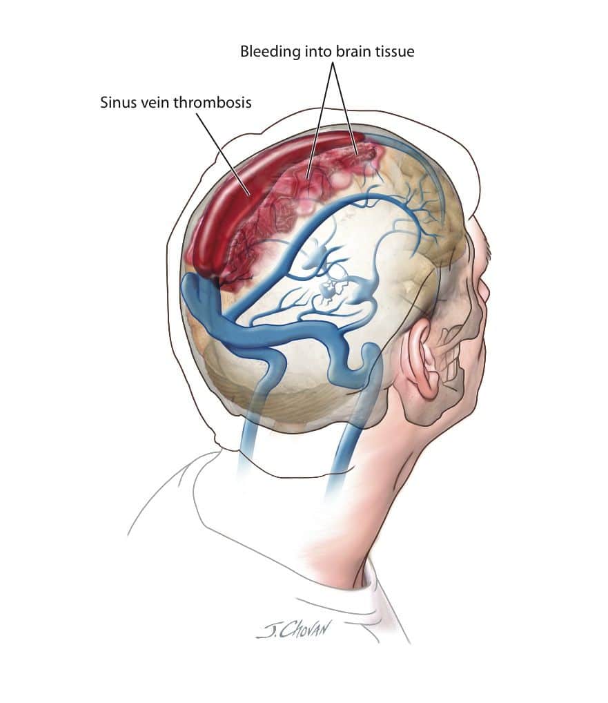 Sinus and Cerebral Vein Thrombosis