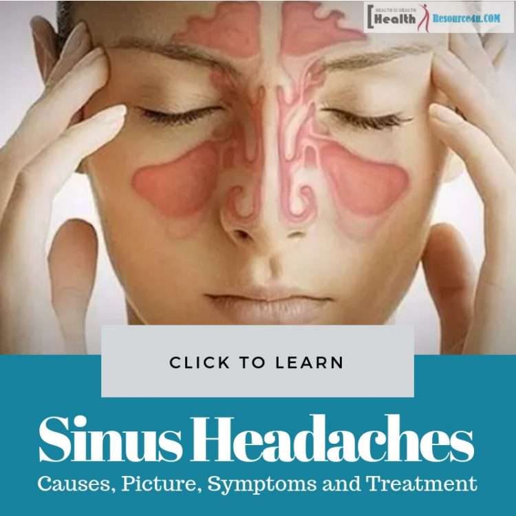 Sinus Headaches: Causes, Picture, Symptoms and Treatment
