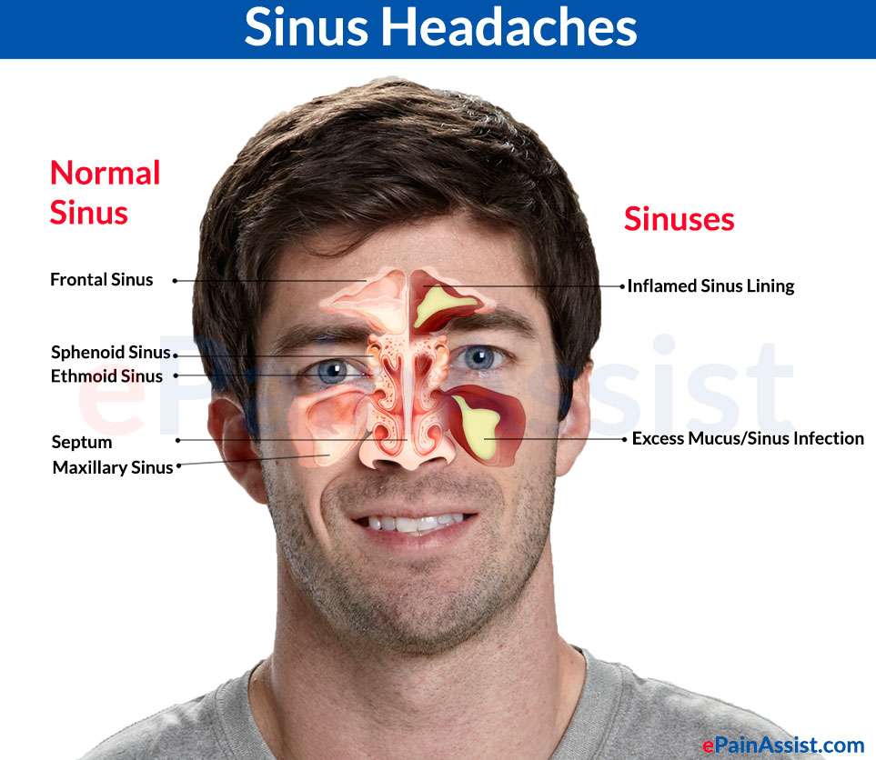 Sinus Headaches: Treatment, Prevention, Differentiating it from Migraine