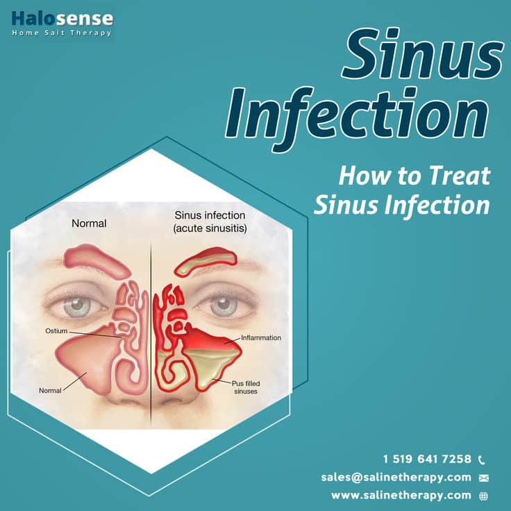 Sinus Infection: How to Treat Sinus Infection