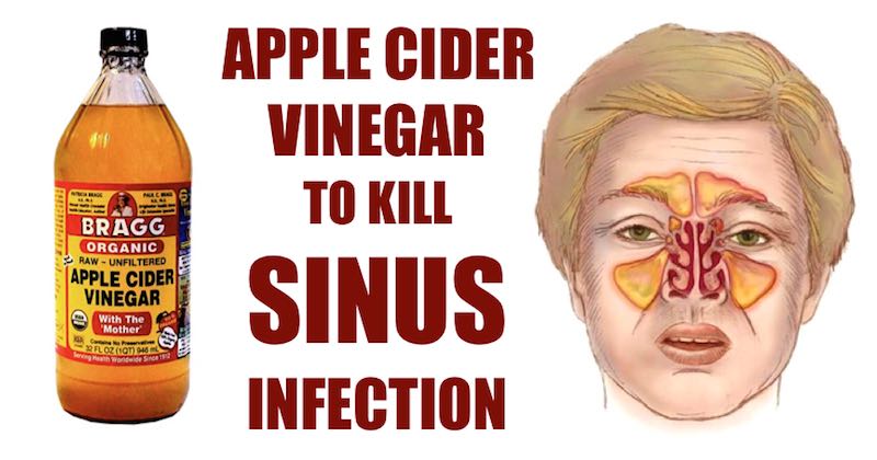 Sinus Infection