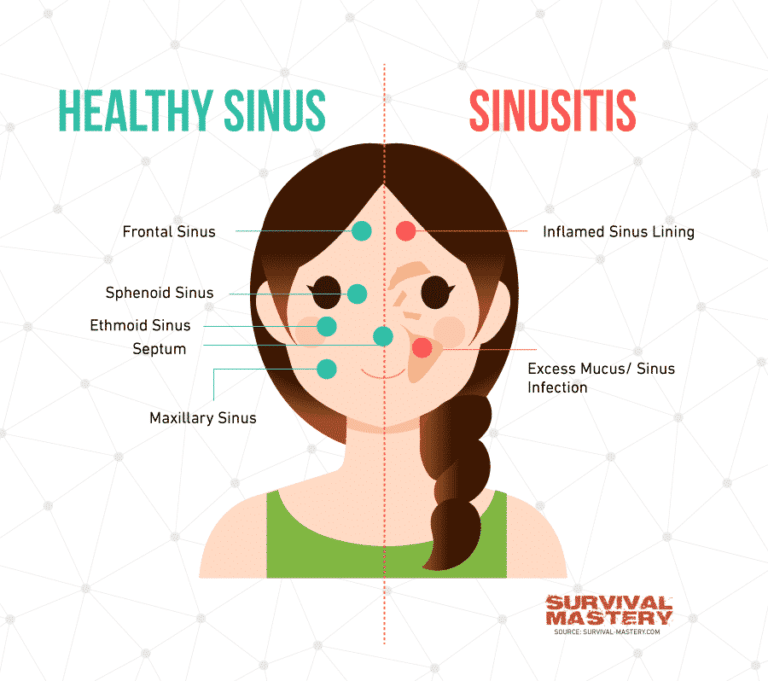 Sinus Infection Treatment: Complete List of Best Remedies
