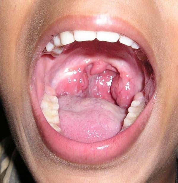 Sinus inflammation Roof Of Mouth