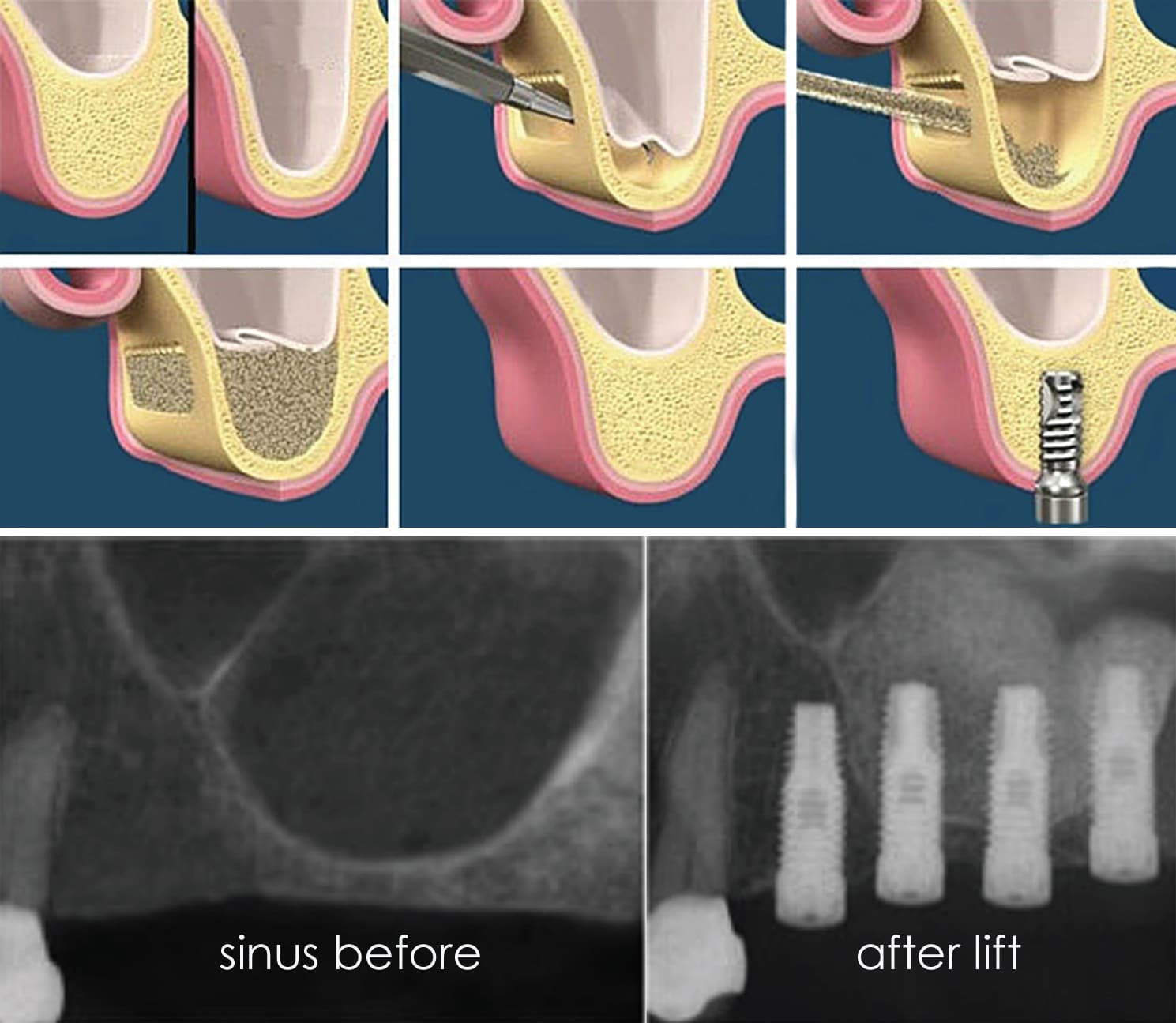 Sinus Lift makes implant possible for some