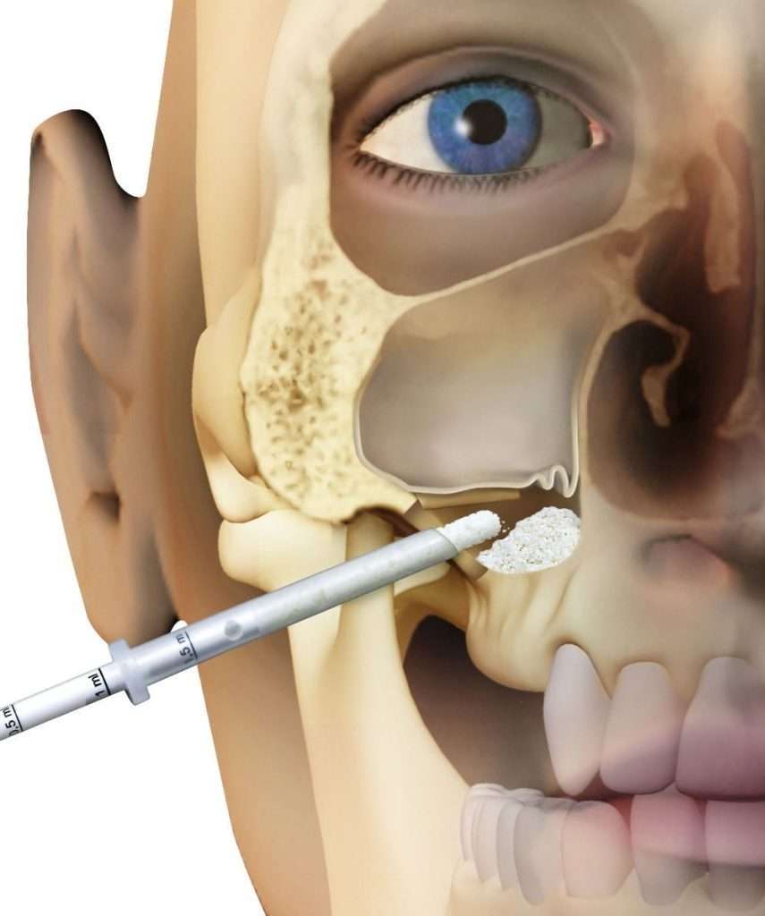 Sinus lift surgery for Dental Implants