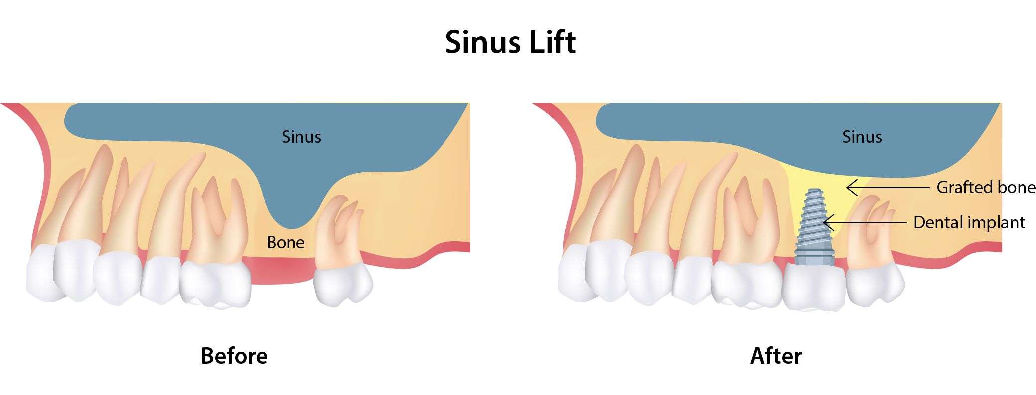 Sinus Lift Surgery
