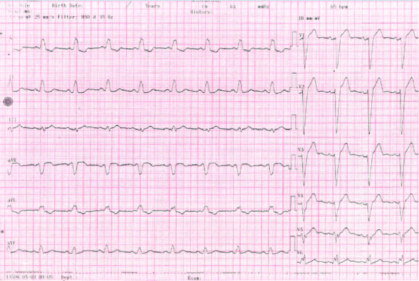 Sinus rhythms with LBBB after electrical cardioversion ...