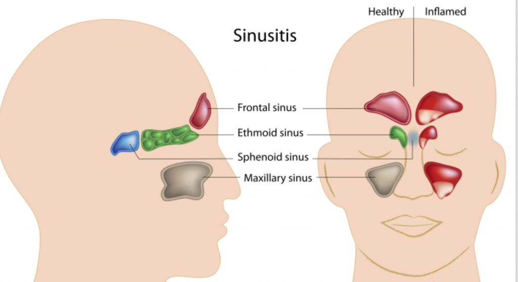 Sinusitis and Toothache 101: How are they related to each ...