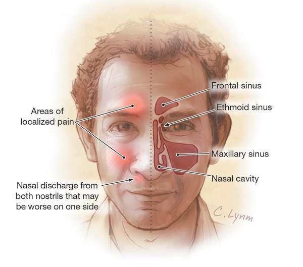 Sinusitis. Causes, symptoms, treatment Sinusitis