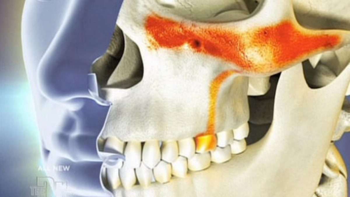 Sinusitis Pain In Teeth