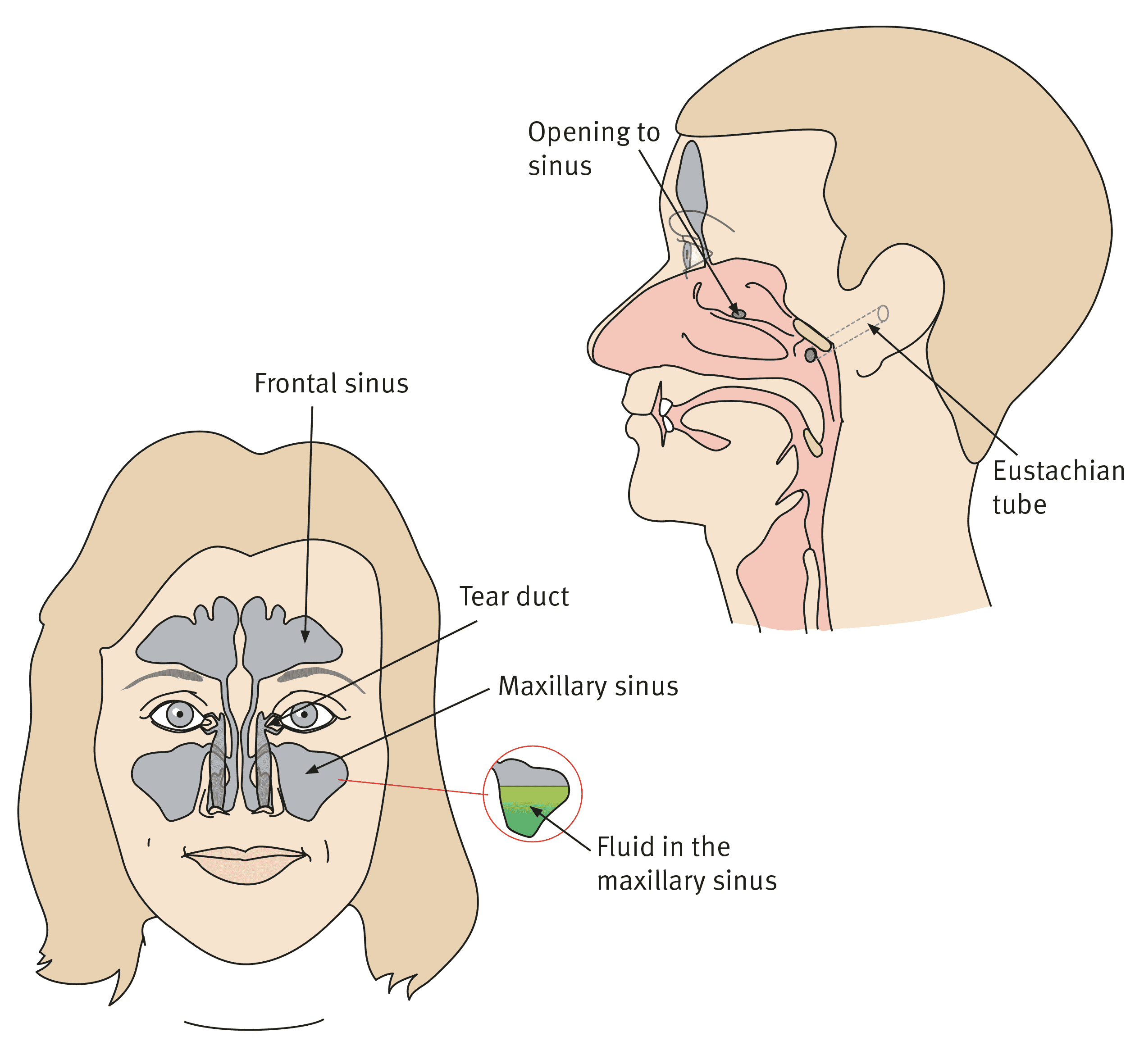 Sinusitis (sinus infection)
