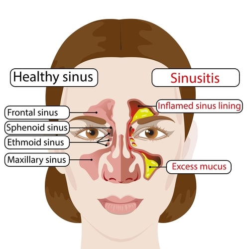 Sinusitis: Symptoms, Diagnosis and Treatment  Healthsoul
