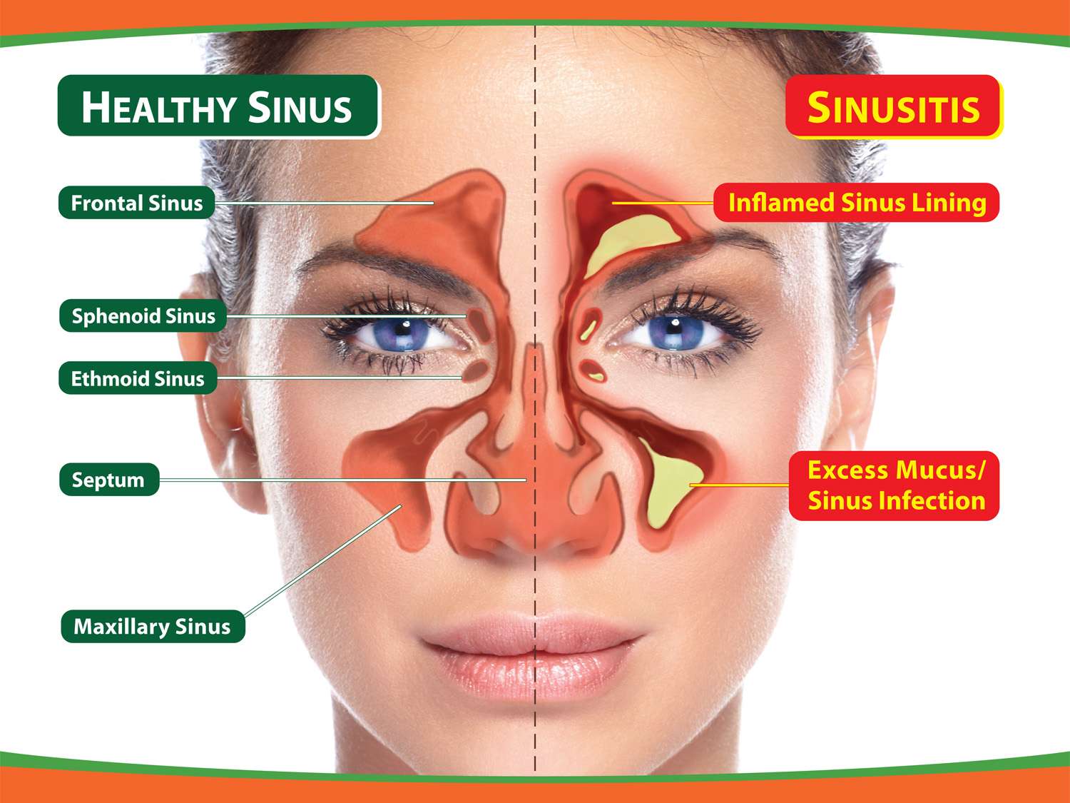 Some Nutrients That Can Help People With Sinus