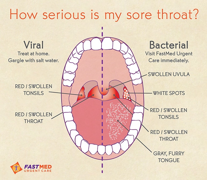 Sore Throat &  Strep (Pharyngitis)