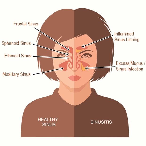 Sphenoid Sinusitis Symptoms Headache