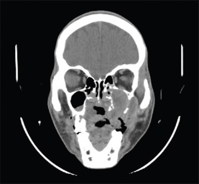 Squamous cell carcinoma of the maxillary antrum mimicking invasive ...