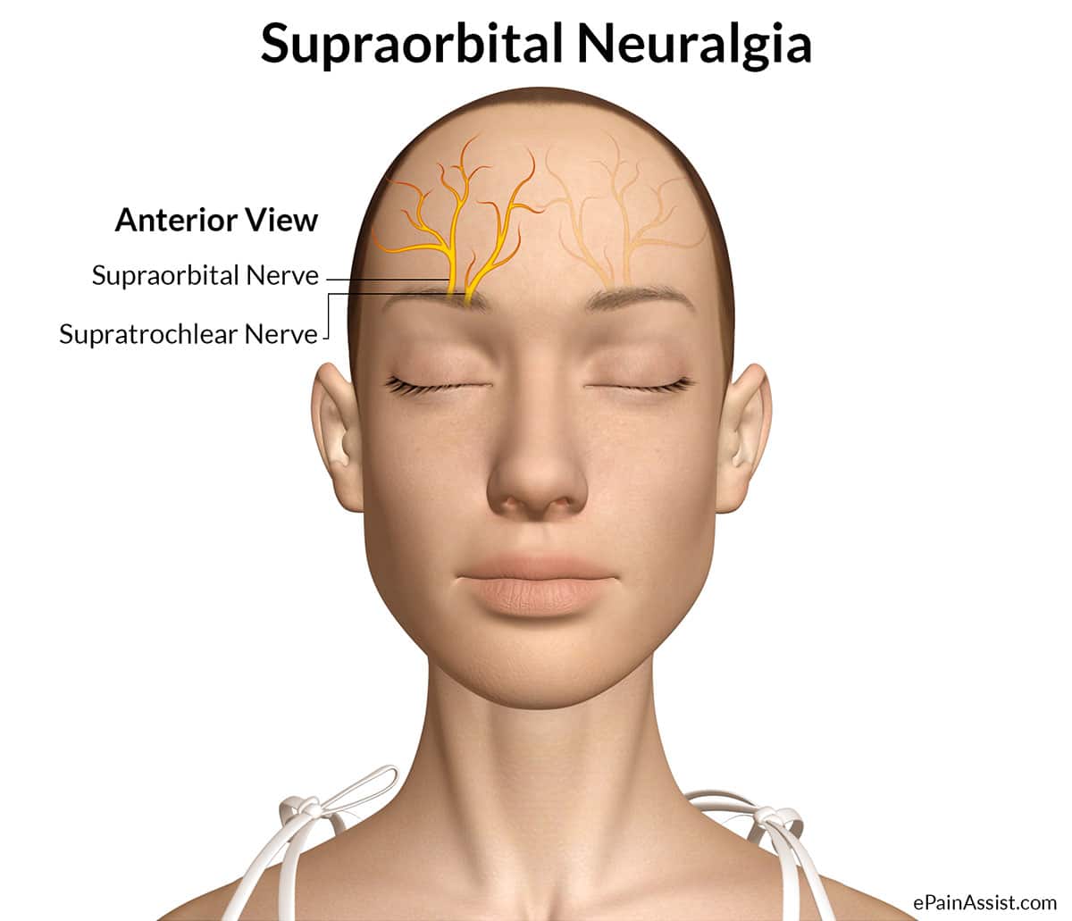 Supraorbital Neuralgia or Goggle Headache
