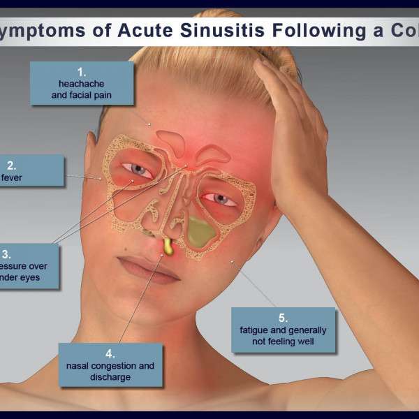Symptoms of Acute Sinusitis Following a Cold ...