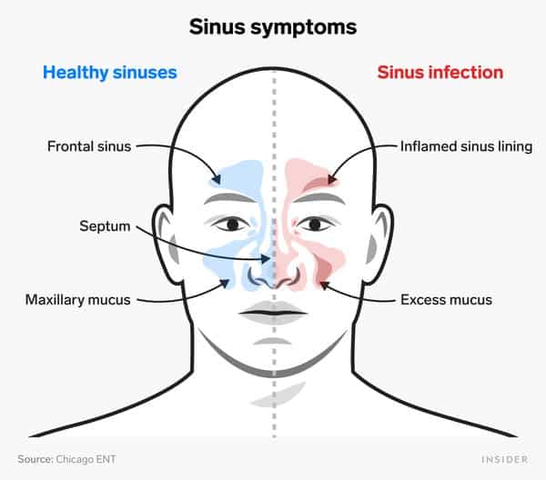 The 5 best home remedies for a sinus infection