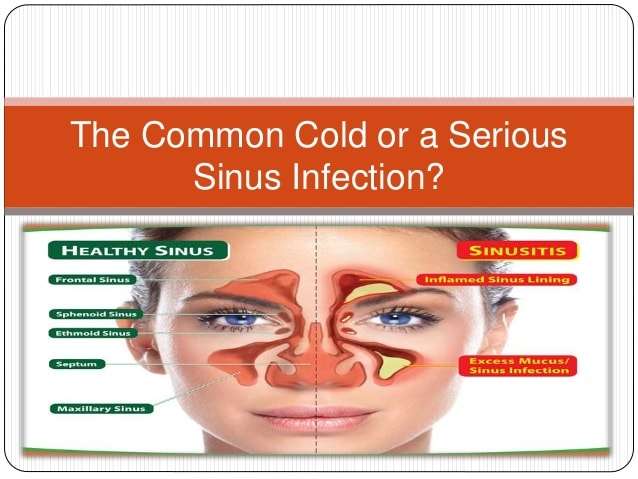 The Common Cold or a Serious Sinus Infection?