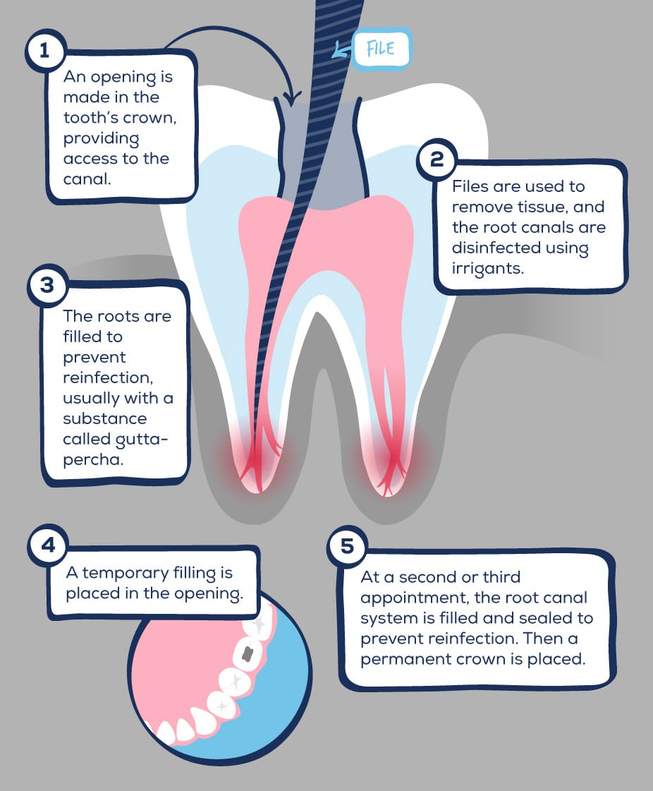 The Cost of a Dental Implant