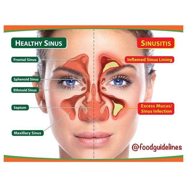 There are two types of sinusitis. They are acute sinusitis (lasts for ...