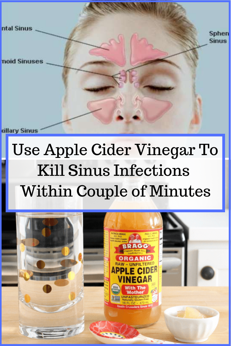 Use Apple Cider Vinegar To Kill Sinus Infections Within Couple of ...