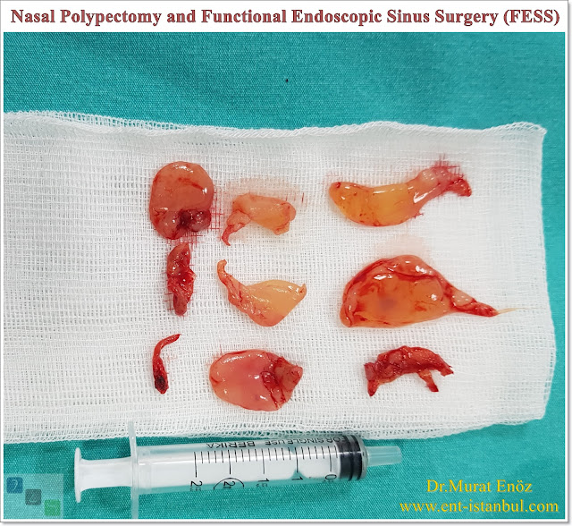 We Performed Nasal Polypectomy and Functional Endoscopic Sinus Surgery ...