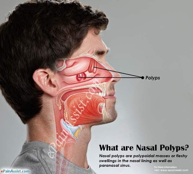 What are Nasal Polyps, Know its Causes, Symptoms, Treatment