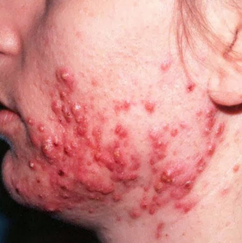 what is acne conglobata