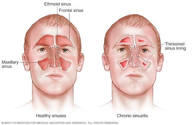 What is chronic sinusitis?