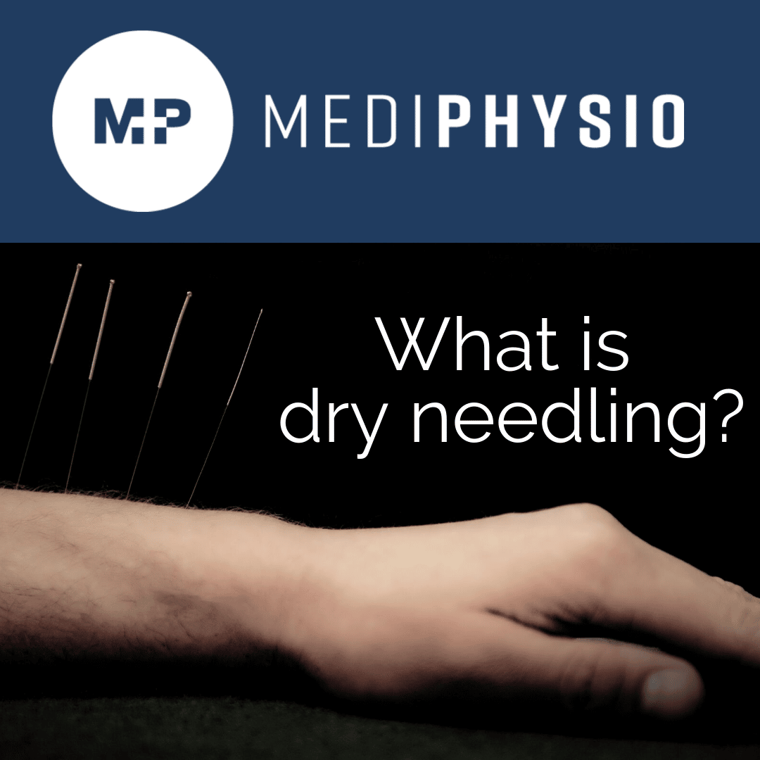 What is dry needling and how can it benefit me?