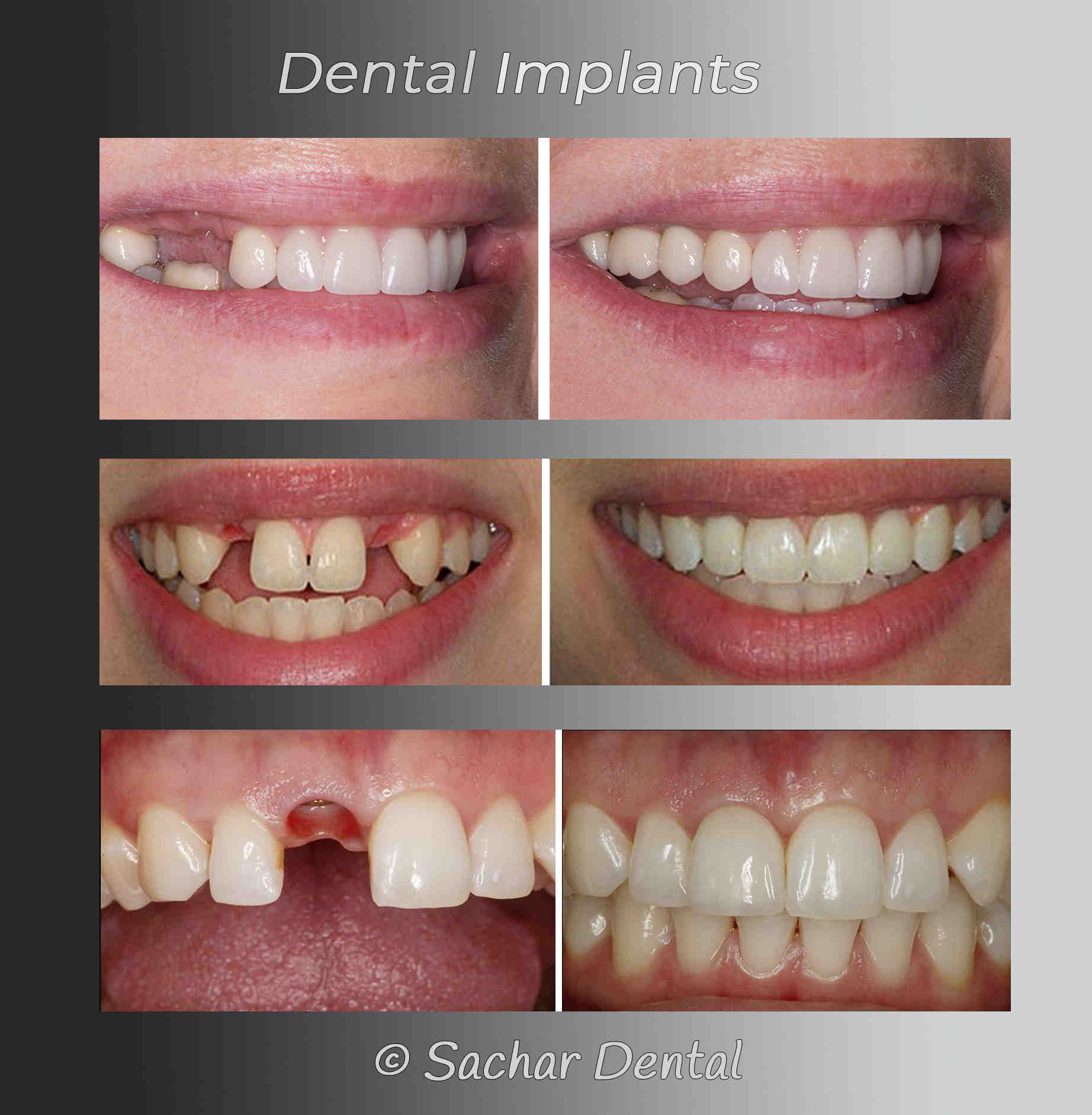 Which dental plan covers implants