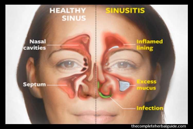 Why a Deviated Septum Can Lead to Chronic Sinus Infections